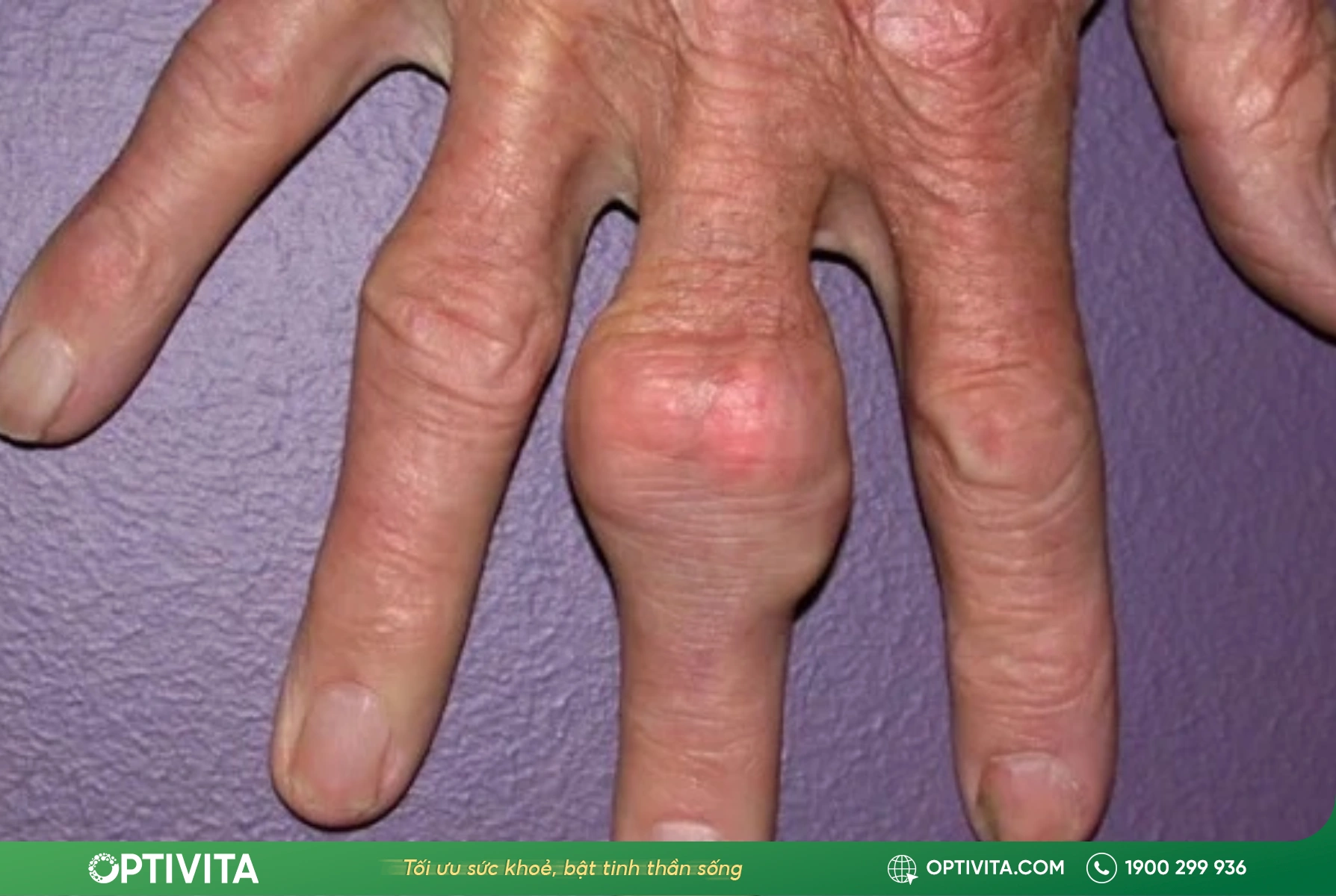 Dấu hiệu và triệu chứng cảnh báo bệnh gout