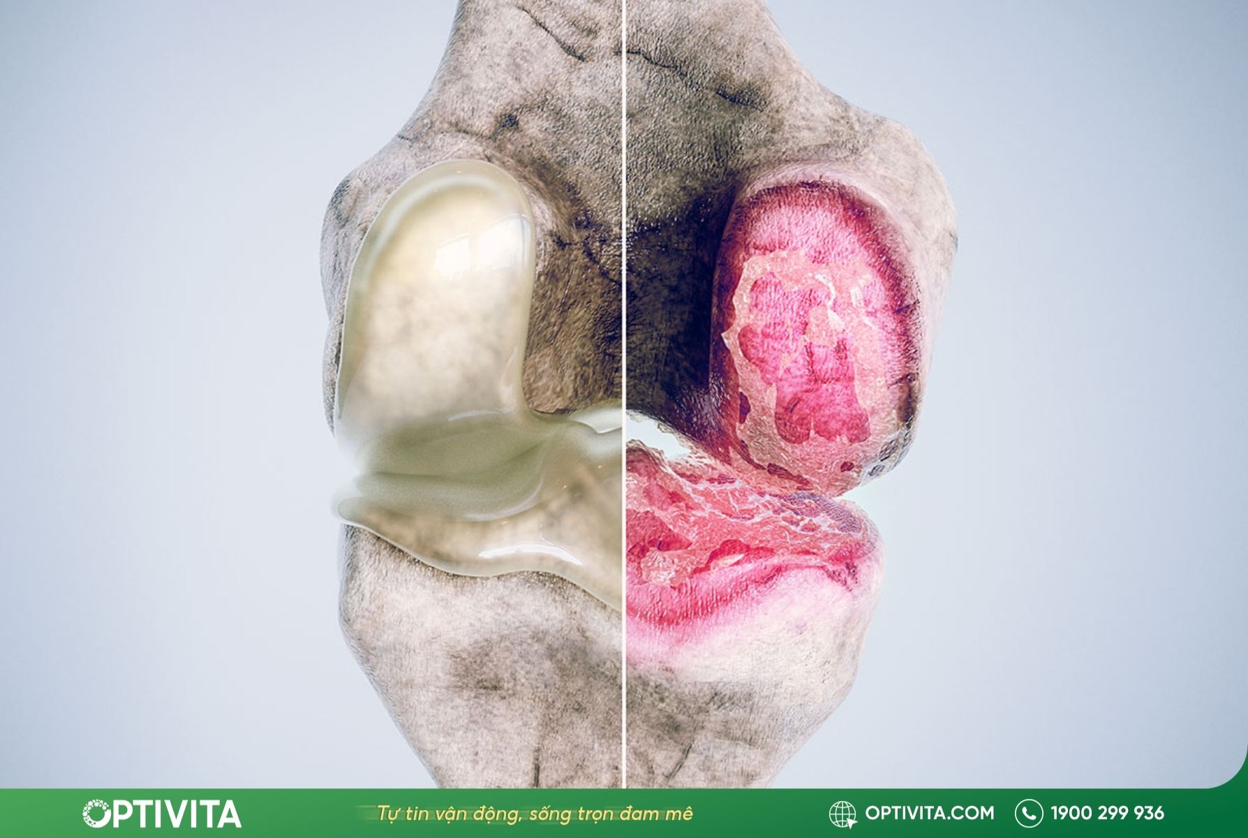 Mòn khớp gối: Nguyên nhân hàng đầu và 8 cách điều trị hiệu quả 10 Nguy cơ thoái hóa khớp gối toàn phần từ mòn khớp gối