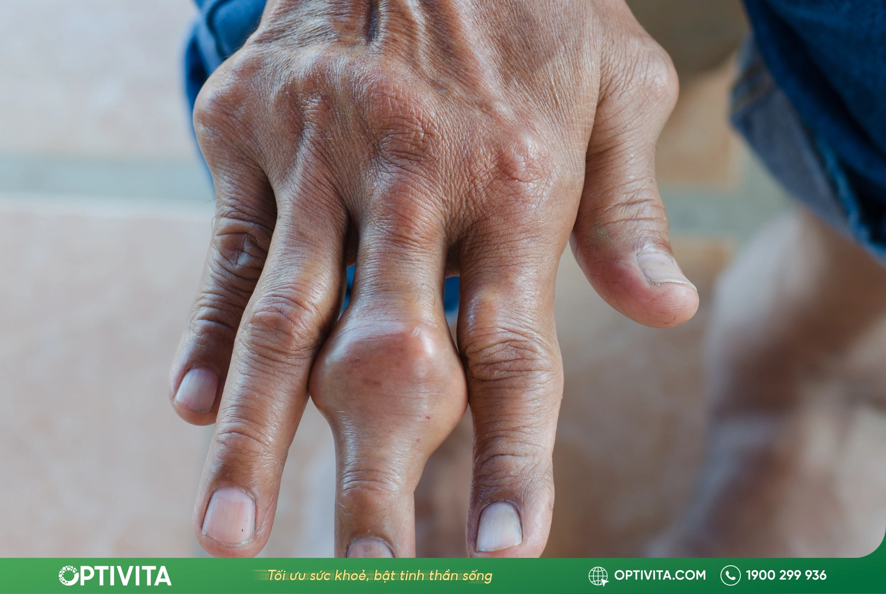 nhức mỏi xương khớp có thể là dấu hiệu của gout