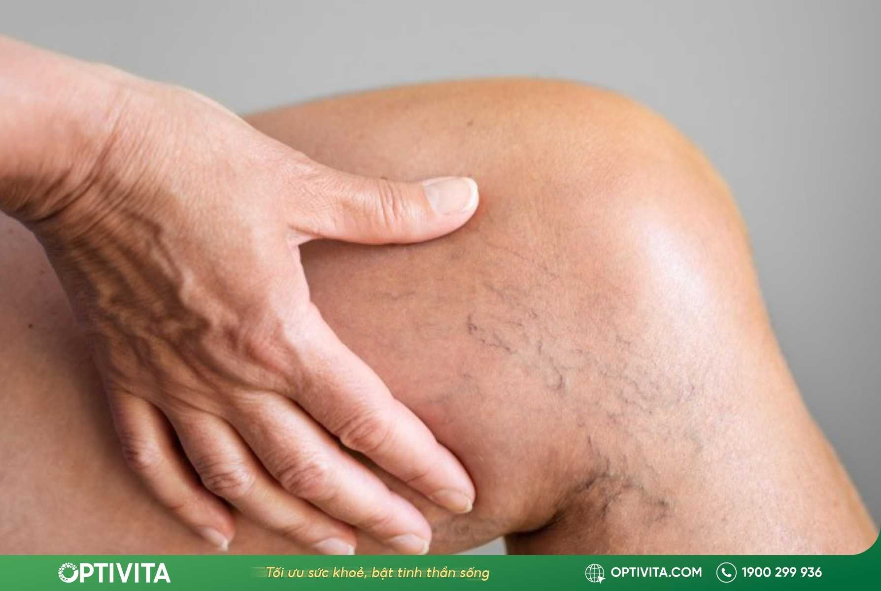 Huyết khối tĩnh mạch sâu gây đau chân từ đầu gối trở xuống