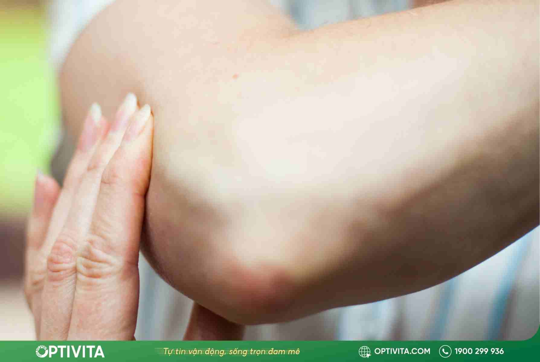 5 dấu hiệu trật khớp khuỷu tay & cách xử lý chuẩn y khoa 9 Trật khớp khuỷu tay