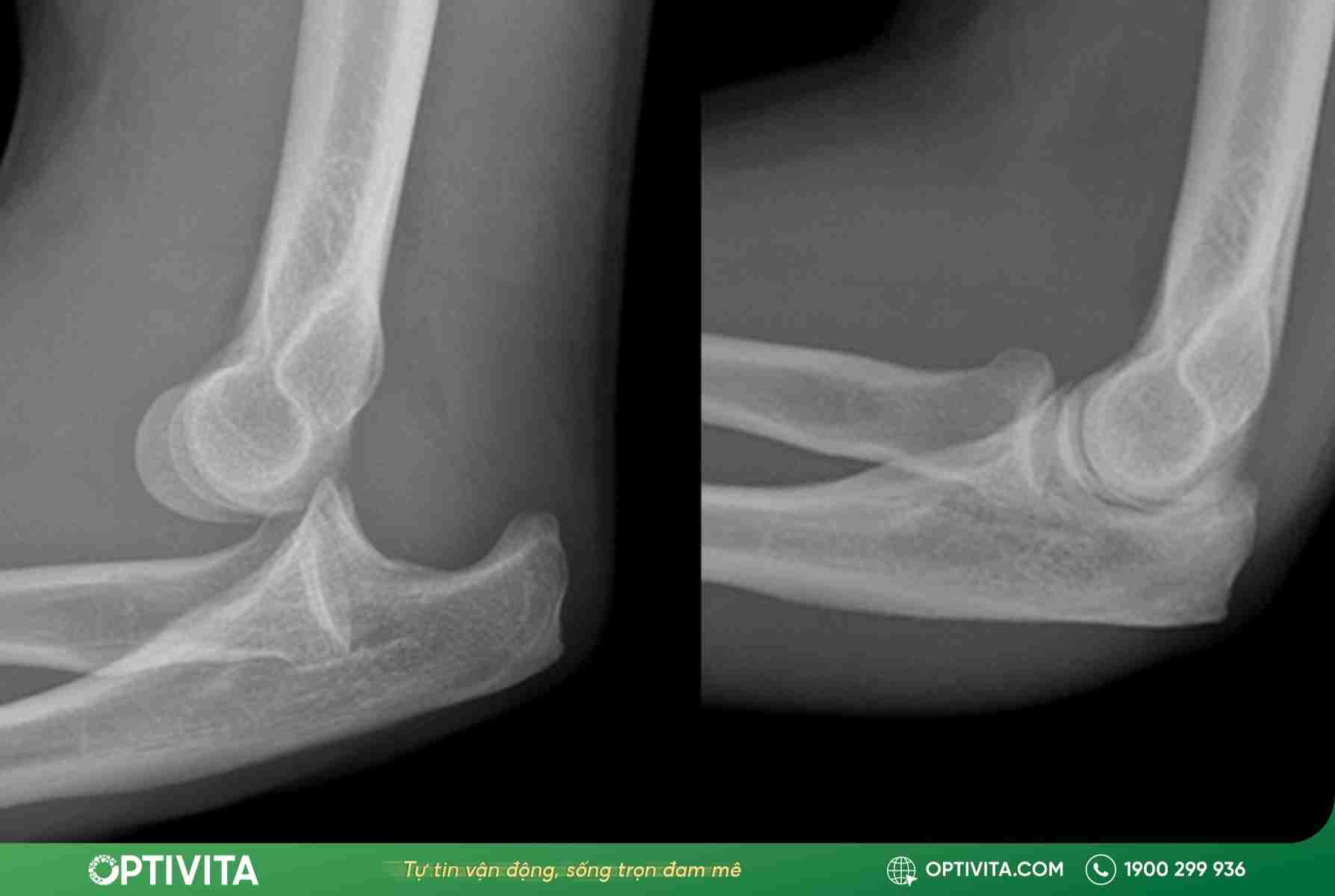 5 dấu hiệu trật khớp khuỷu tay & cách xử lý chuẩn y khoa 10 Trật khớp khuỷu tay