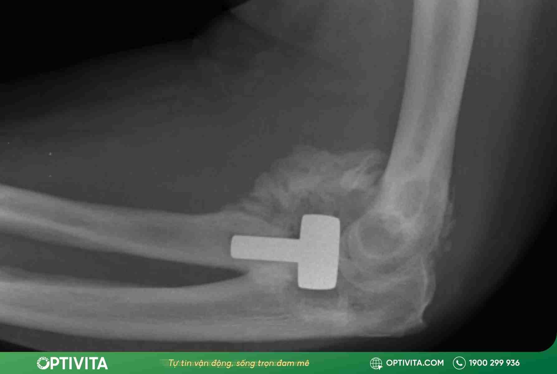 5 dấu hiệu trật khớp khuỷu tay & cách xử lý chuẩn y khoa 12 Trật khớp khuỷu tay