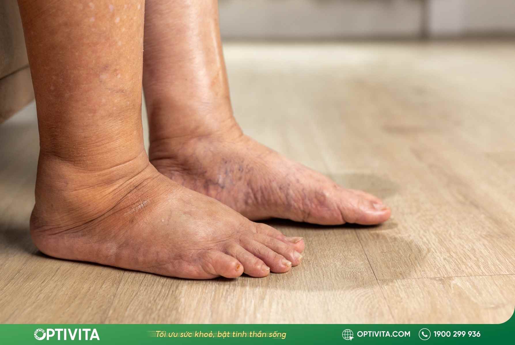 Bật mí 10+ cách giảm sưng khi bị va đập và làm tan máu bầm tại nhà hiệu quả 9 cách giảm sưng khi bị va đập