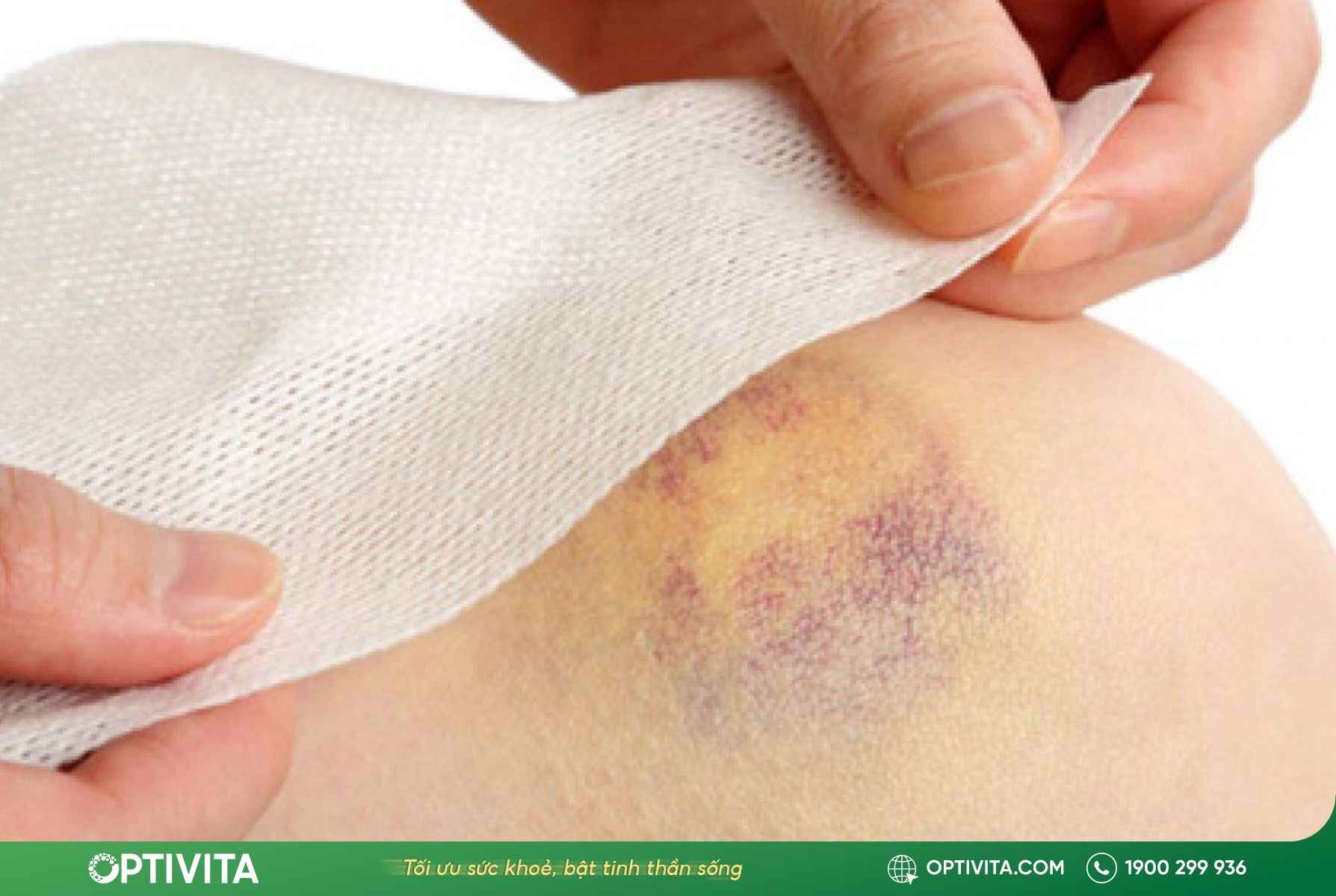 Bật mí 10+ cách giảm sưng khi bị va đập và làm tan máu bầm tại nhà hiệu quả 10 cách giảm sưng khi bị va đập