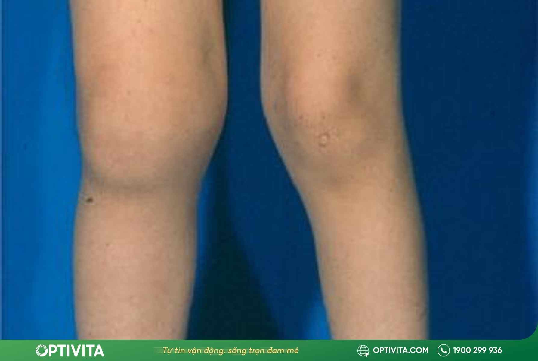 biến dạng khớp do viêm khớp gối ở trẻ em