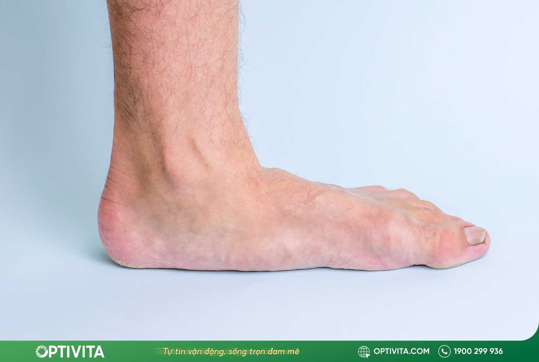 Các vị trí đau lòng bàn chân thường gặp nhất cảnh báo điều gì? 11 các vị trí đau lòng bàn chân