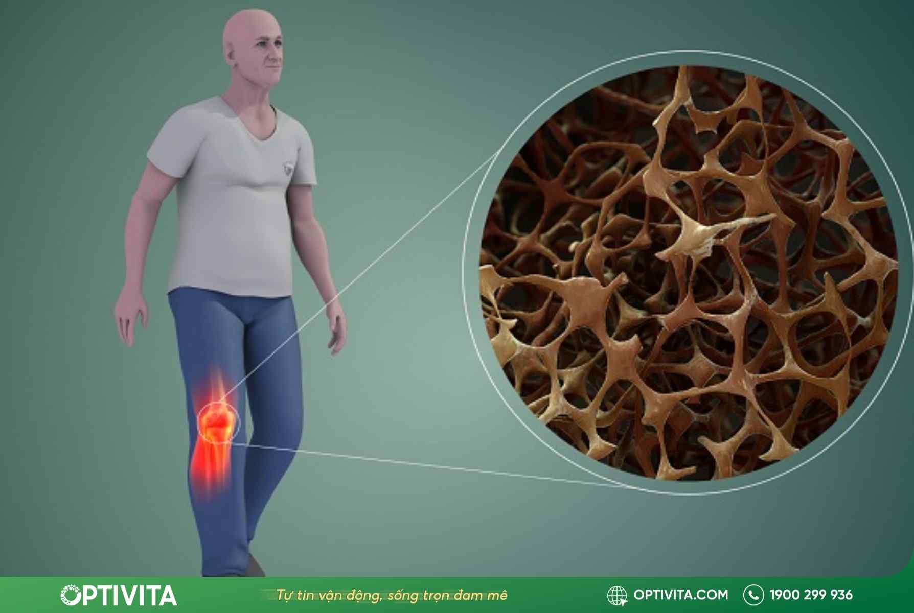 đau nhức xương khớp toàn thân có thể là dấu hiệu loãng xương