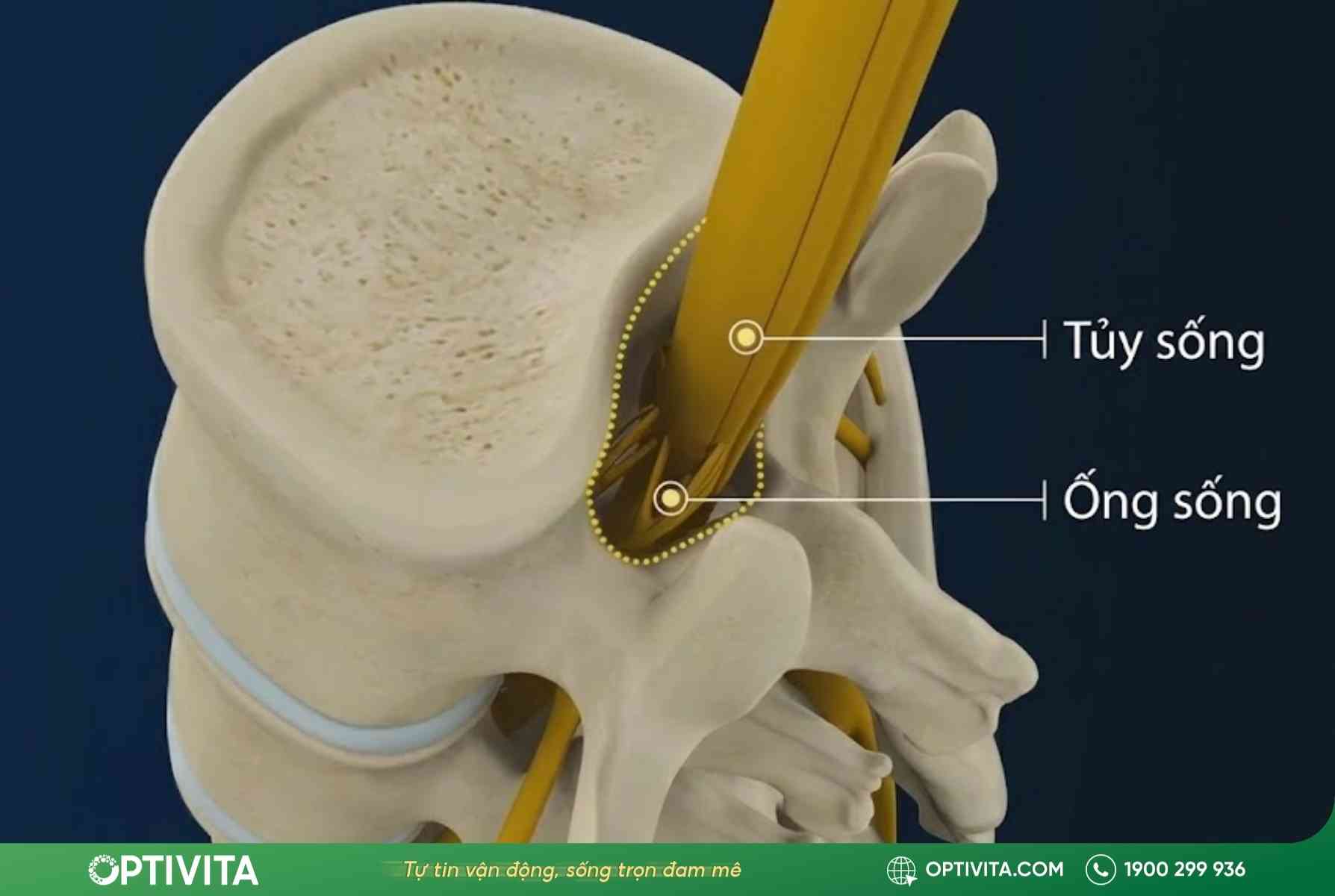 gai cột sống có chữa được không