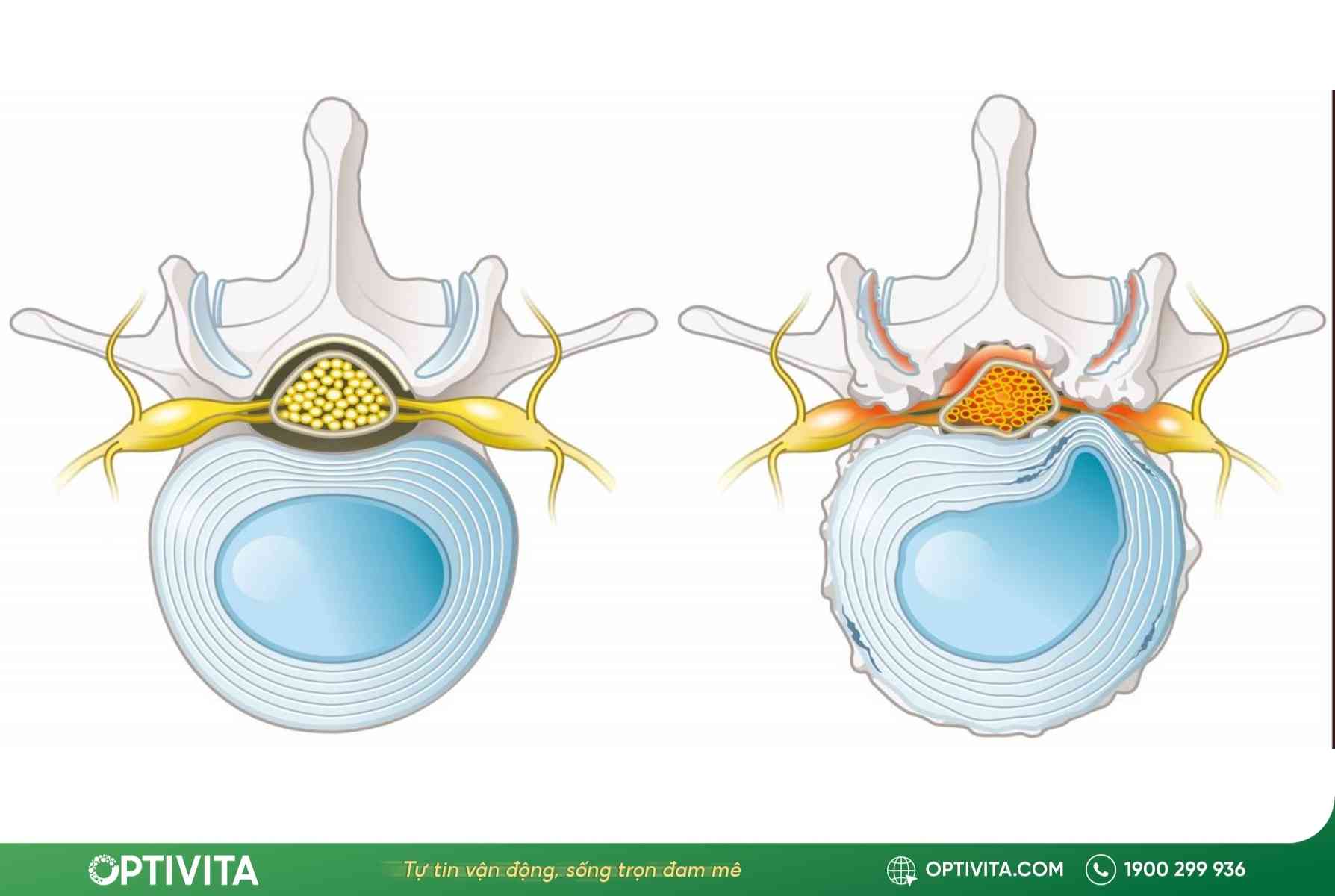 gai cột sống có chữa được không