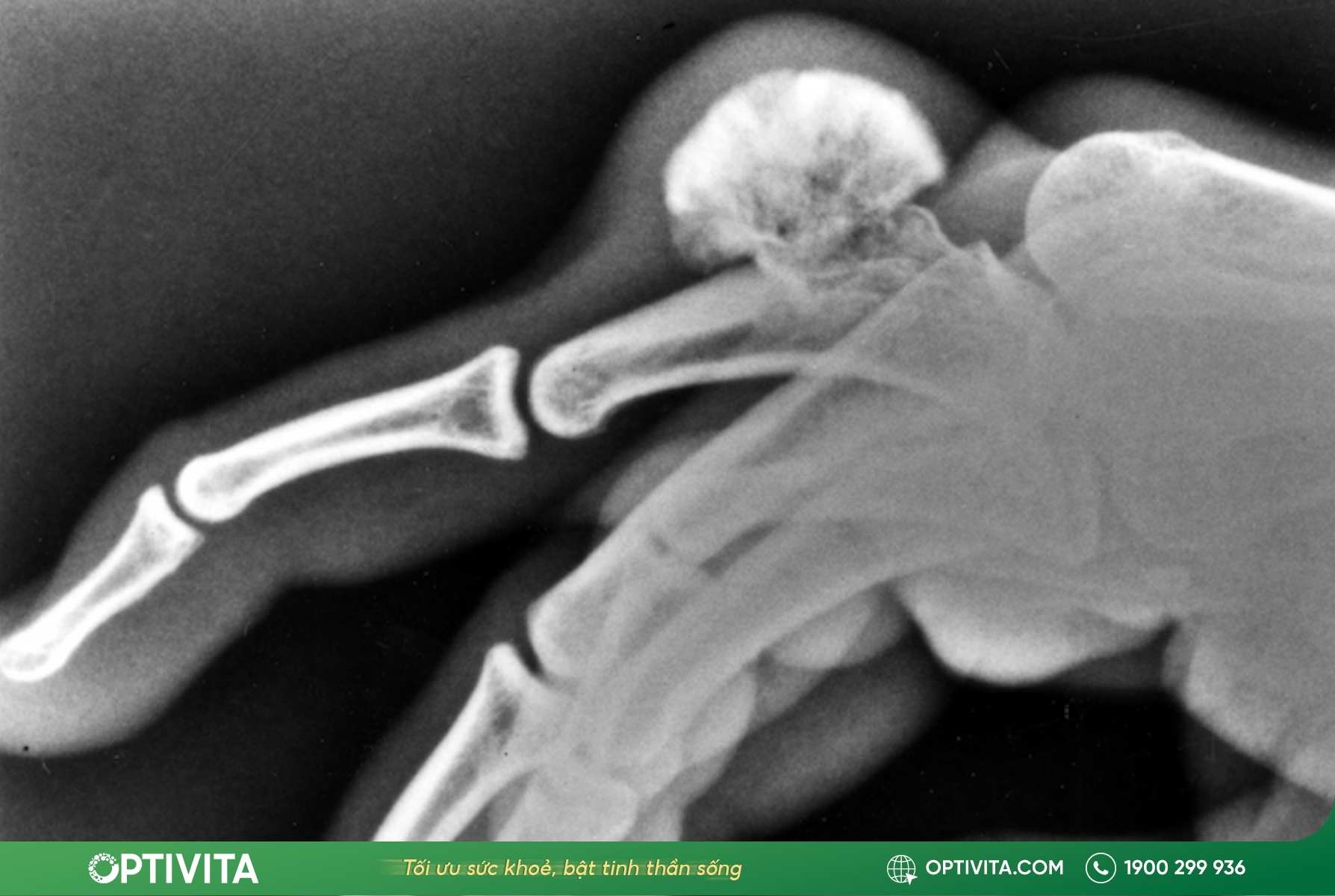 Định nghĩa u xương sụn