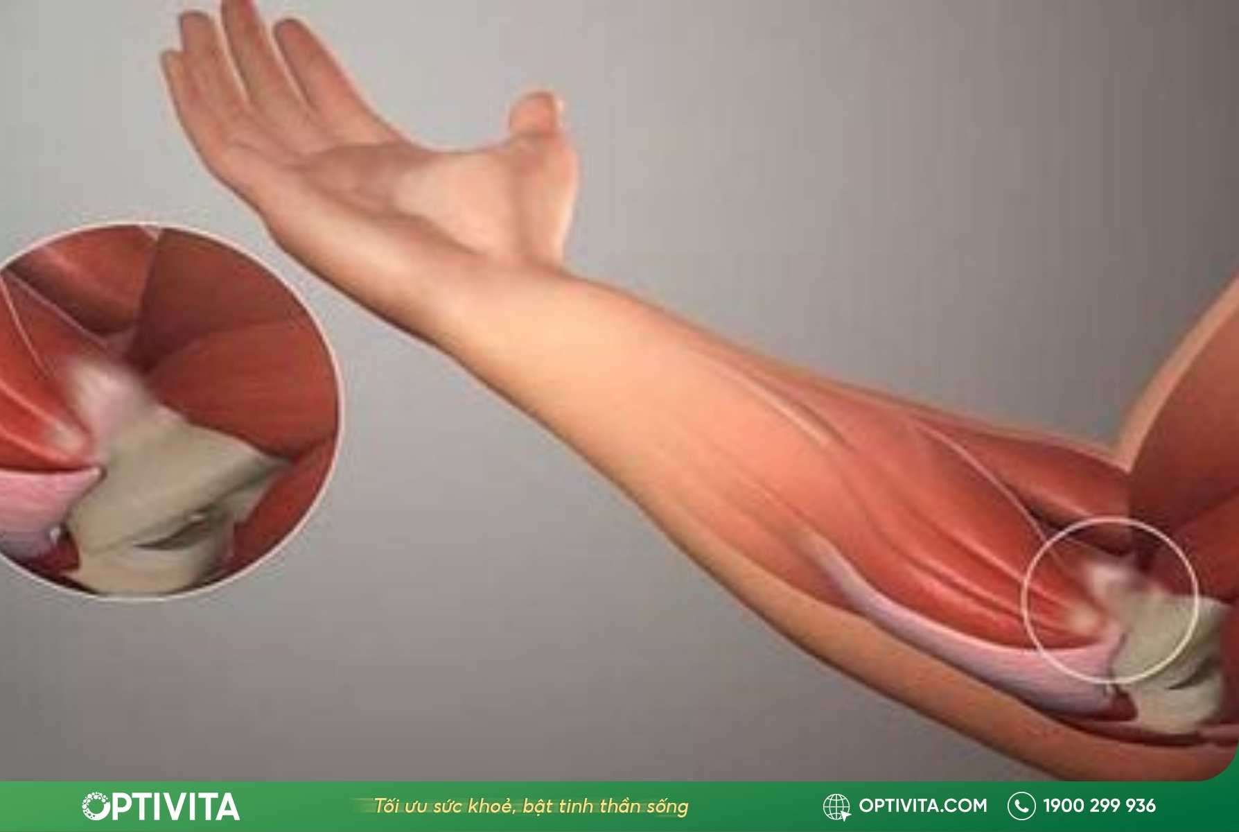 Hệ quả Viêm túi thanh mạc và gân cơ do u xương sụn