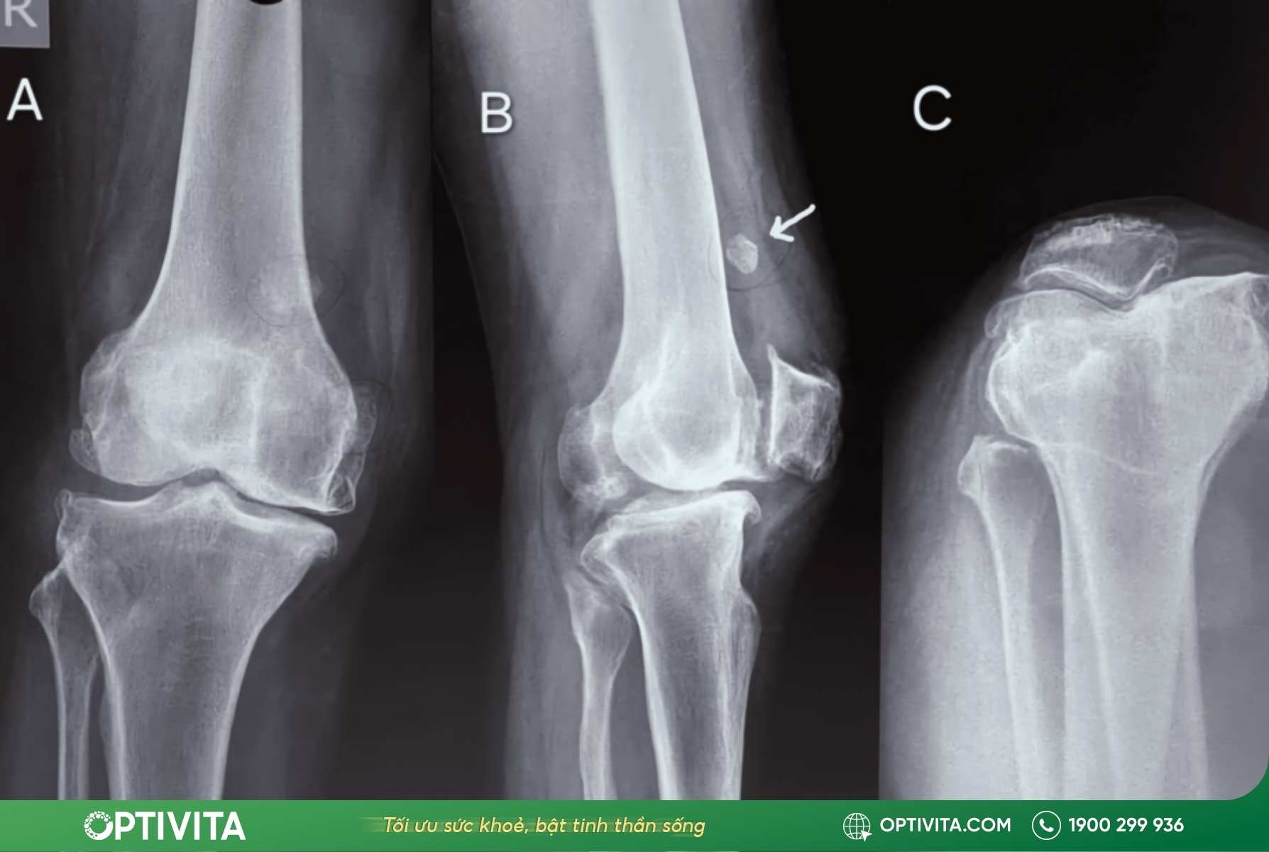 U xương sụn có nguy hiểm không