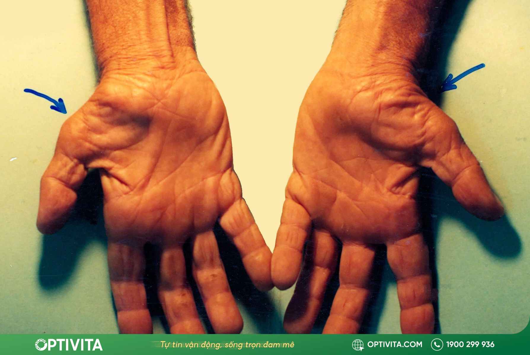 bien-chung-hoi-chung-ong-co-tay-teo-co