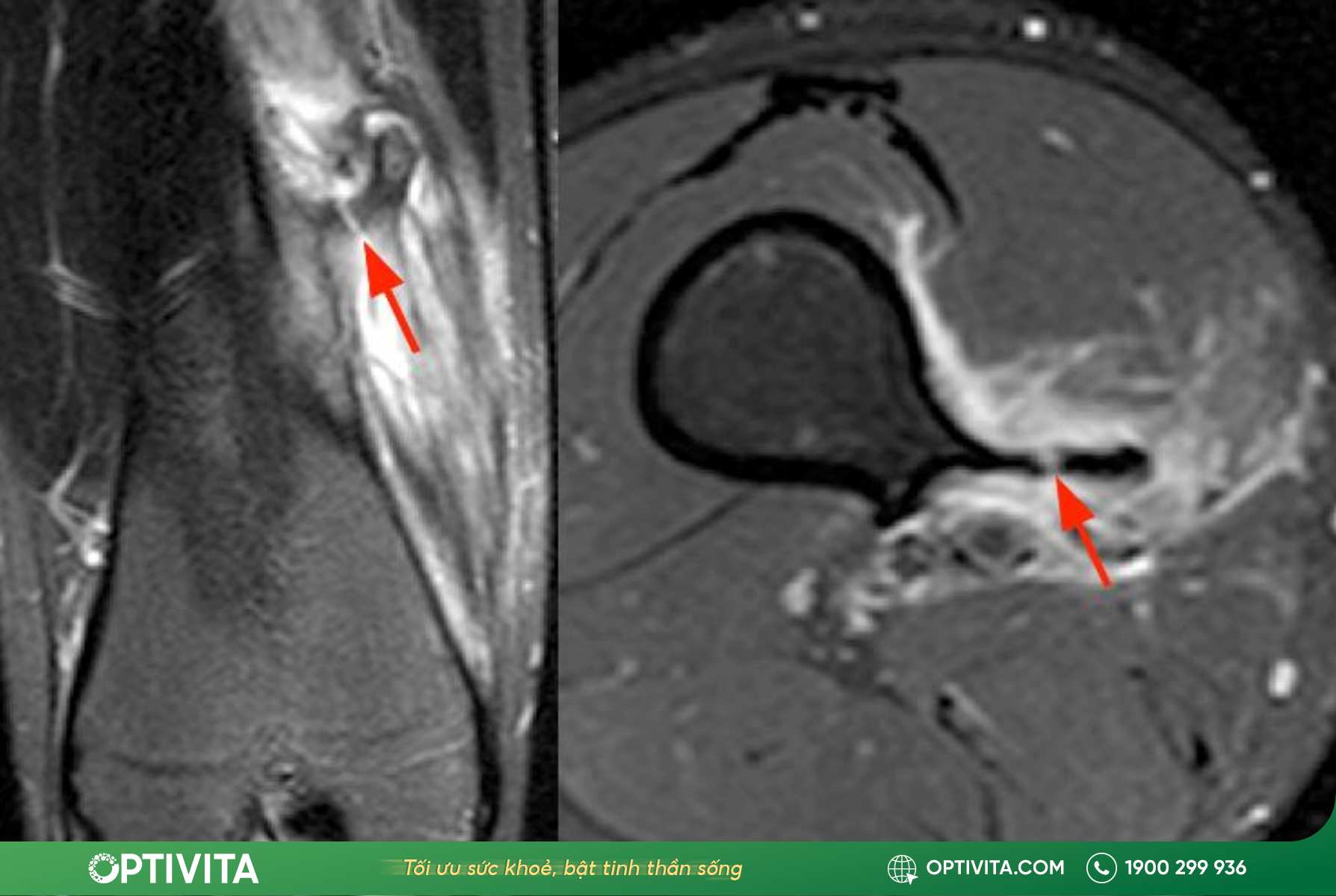chẩn đoán hình ảnh u xương sụn