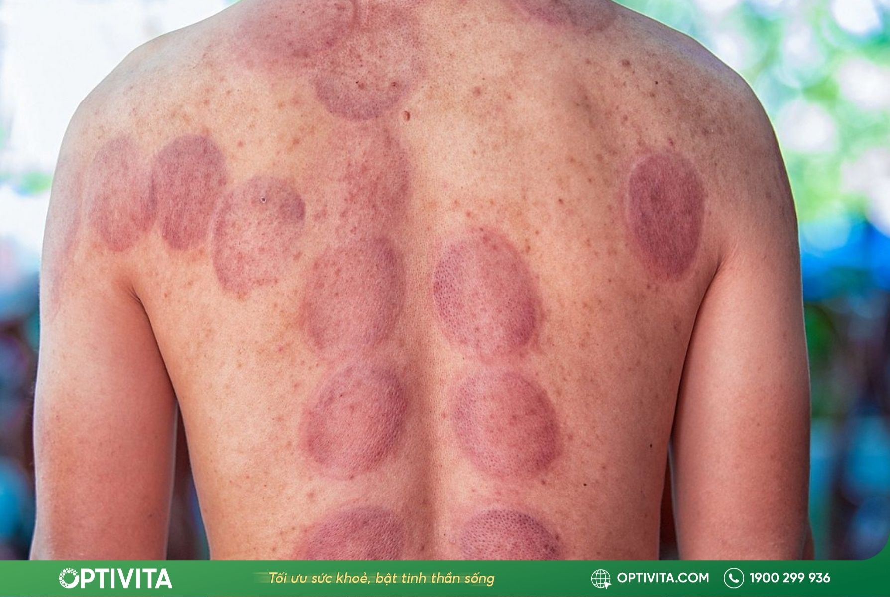 Ý nghĩa màu sắc của các vết bầm tím sau khi giác hơi trị liệu